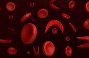 WHO unveils guideline to improve pregnancy out comes in women with SCD