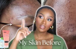 Dimma Umeh Reveals 5 Cleansers Every Black Woman With Acne Should Try