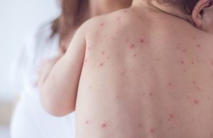 Taraba targets 1.6m children in Measles-Rubella vaccination campaign